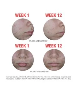 Neutrogena Stubborn Marks PM Treatment 20 Neutrogena Stubborn Marks PM Treatment -Neutrogena Shop 6840028 carousel1 1 1