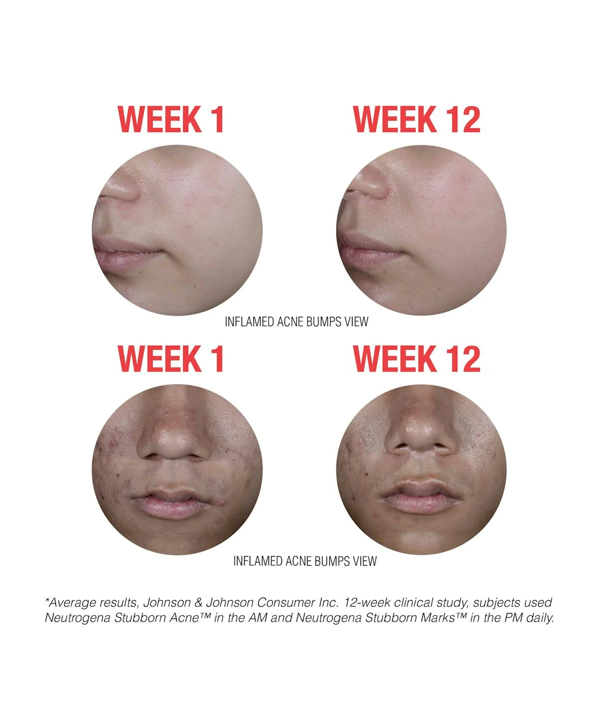 Neutrogena Stubborn Marks PM Treatment 9 Neutrogena Stubborn Marks PM Treatment - Image 7