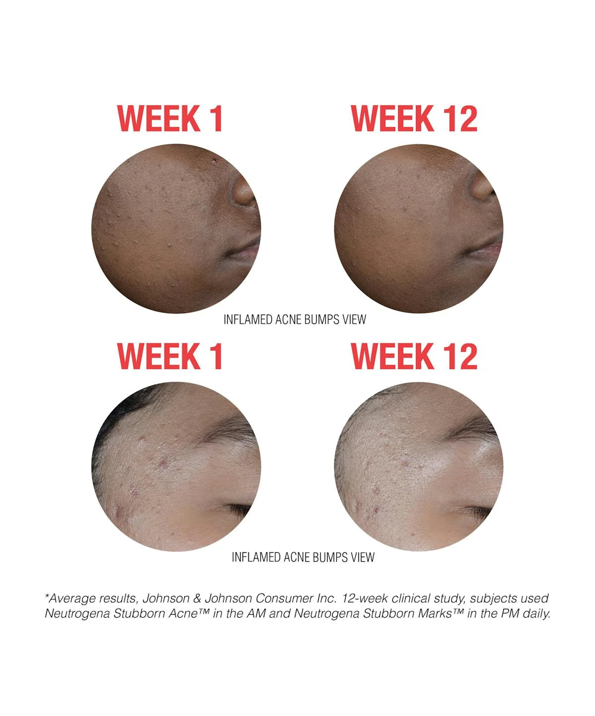 Neutrogena Stubborn Marks PM Treatment 10 Neutrogena Stubborn Marks PM Treatment - Image 8